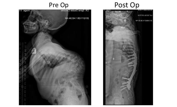 Pre and Post operative radiographs following kyphosis correction.