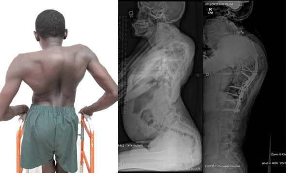 A 15 year old male from Sierra Leone with a 170º proximal thoracic kyphosis due to spinal tuberculosis. Pre and Post operative radiographs following kyphosis correction.