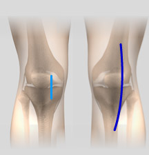 Minimally Invasive Knee Knee Replacement, New York NY