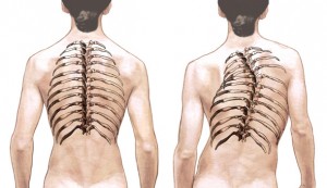 #100 Scoliosis - ILLUS