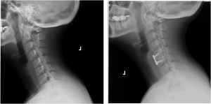 ACDF Pre-Post Op