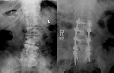 Adult Scoliosis - Pre & Post-Op adult degenerative scoliosis