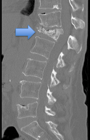 Vertebral Compression Fractures