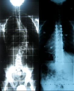 adolescent idiopathic scoliosis