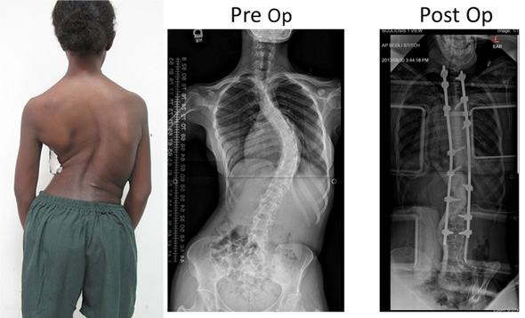 A 21 year old Ethiopian female with a 70° scoliosis curve. Pre and Post operative radiographs following scoliosis correction.