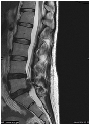 Pre-operative MRI