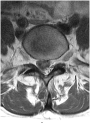 Pre-operative MRI