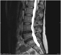 Post-operative MRI