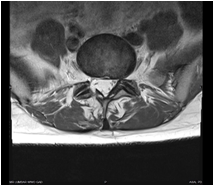 Post-operative MRI