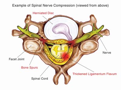 surgery spinal stenosis